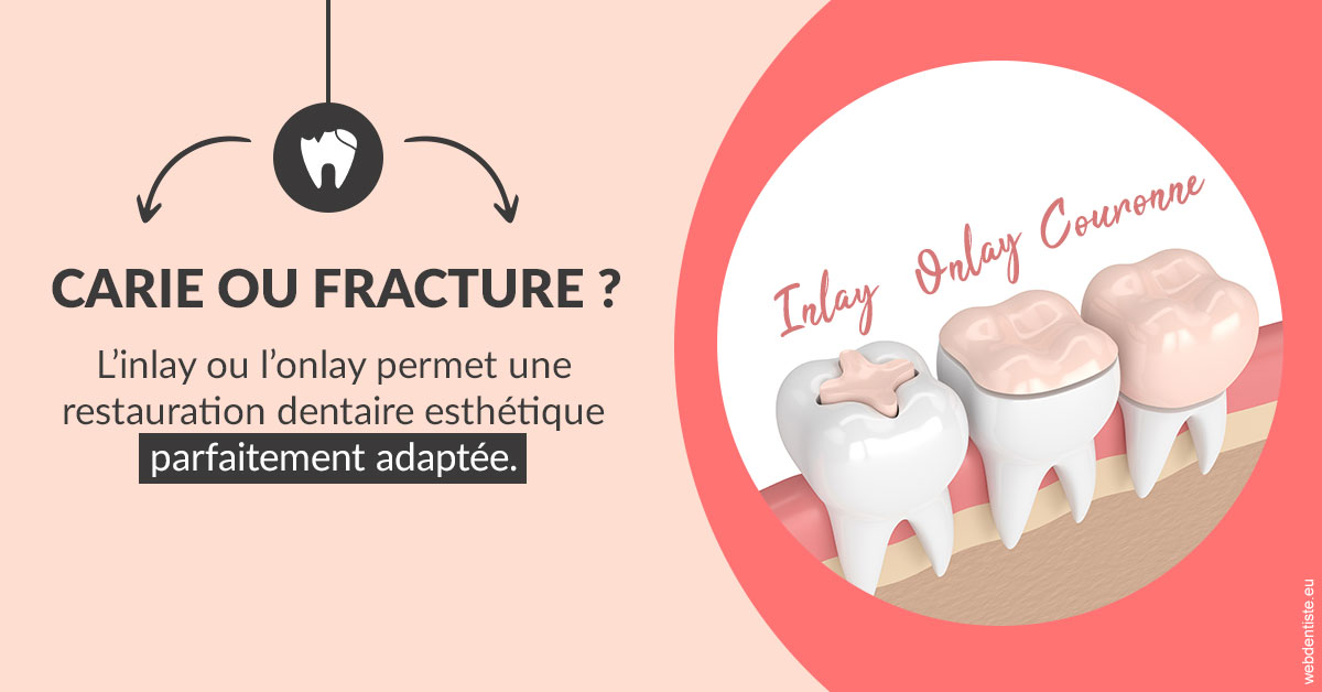 https://www.docteurs-el-khoury-hanna.fr/T2 2023 - Carie ou fracture 2