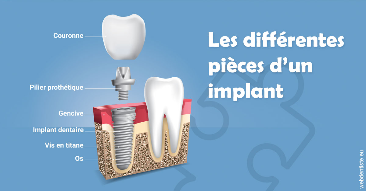 https://www.docteurs-el-khoury-hanna.fr/Les différentes pièces d’un implant 1