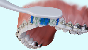 Brossettes et brackets orthodontiques